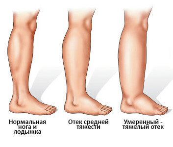 Отечность – еще один признак гепатита С- фото № 3 Отечность – еще один признак гепатита С