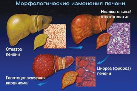 Гепатит С: что делать?- фото № 1 Гепатит С: что делать?