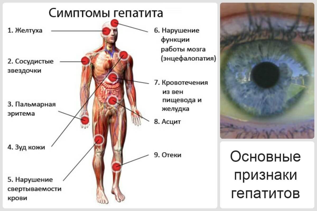 Что нужно знать о симптомах гепатита С- фото № 3 Что нужно знать о симптомах гепатита С