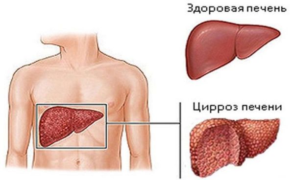 Острый и хронический гепатит С: в чем разница?- фото № 2 Острый и хронический гепатит С: в чем разница?