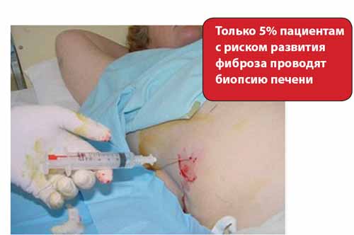 Чтобы вирусный гепатит С обошел стороной- фото № 2 Чтобы вирусный гепатит С обошел стороной