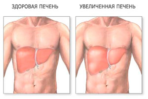Как долго можно прожить c HCV?- фото № 2 Как долго можно прожить c HCV?
