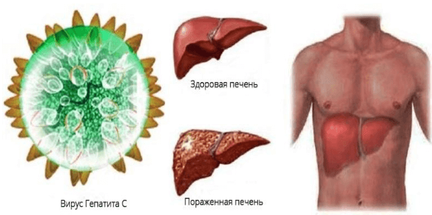 Заразен ли человек гепатитом С после лечения Заразен ли человек гепатитом С после лечения?