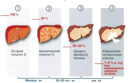 Особенности лечения 5 генотипа гепатита С- фото № 1 Особенности лечения 5 генотипа гепатита С