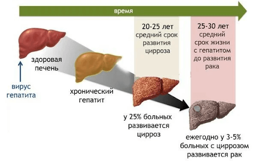 Как избежать осложнений при гепатите С- фото № 1 Как избежать осложнений при гепатите С