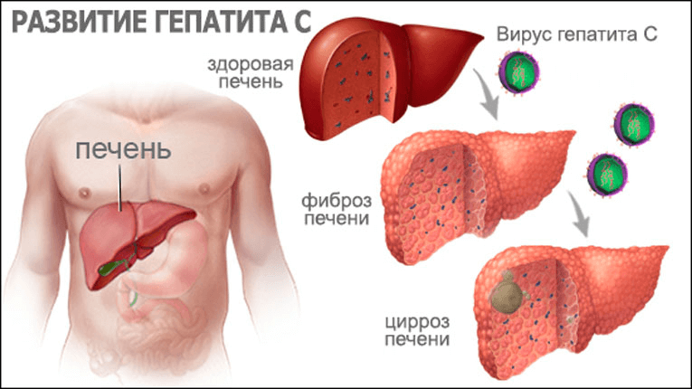 Смертельно опасные последствия гепатита С- фото № 1 Смертельно опасные последствия гепатита С